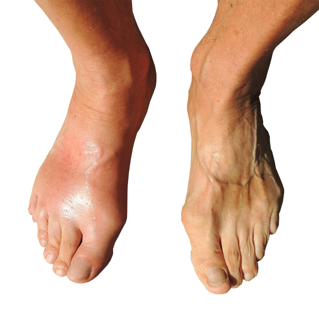 Decreased Inflammation of the feet.